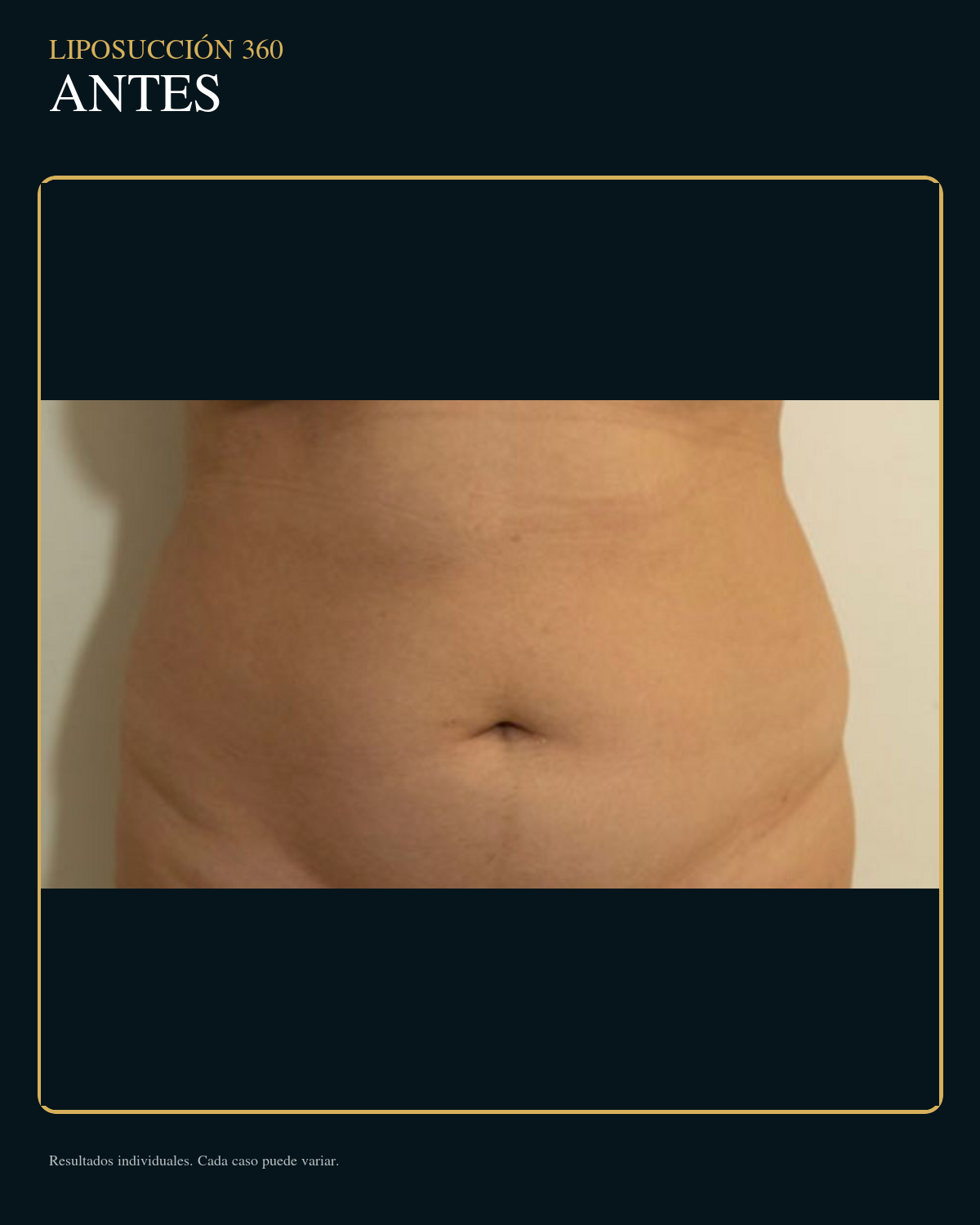 Antes de liposucción 360