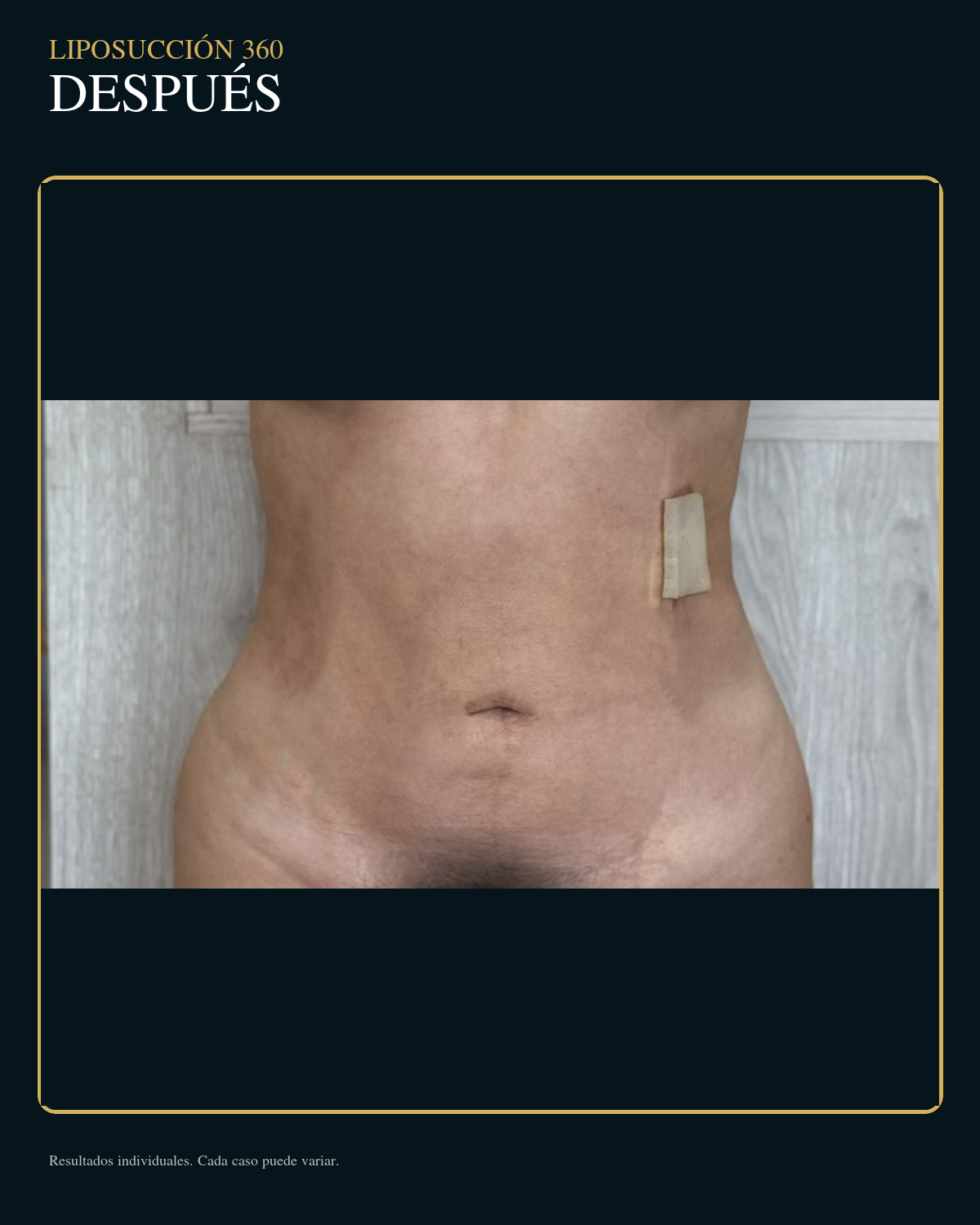 Después de liposucción 360