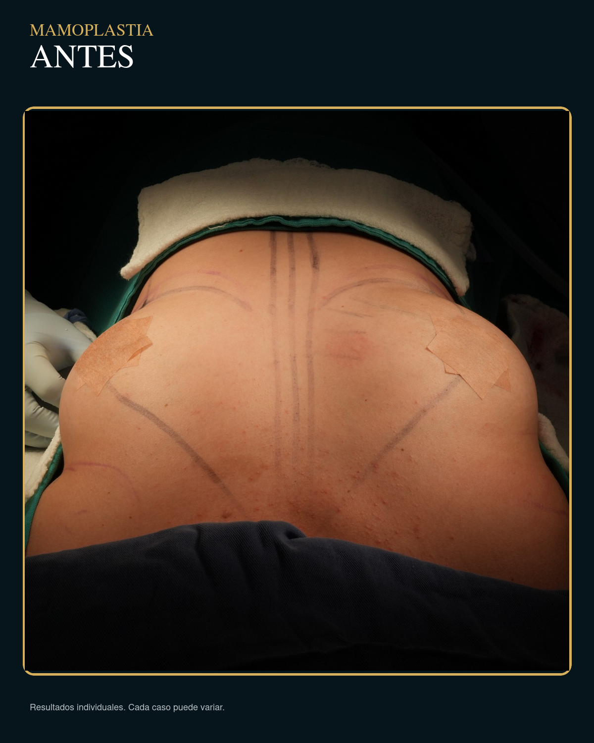 Antes de mamoplastia