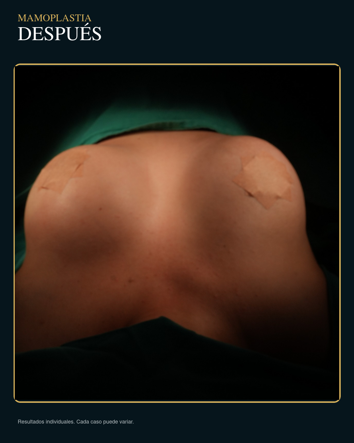 Después de mamoplastia