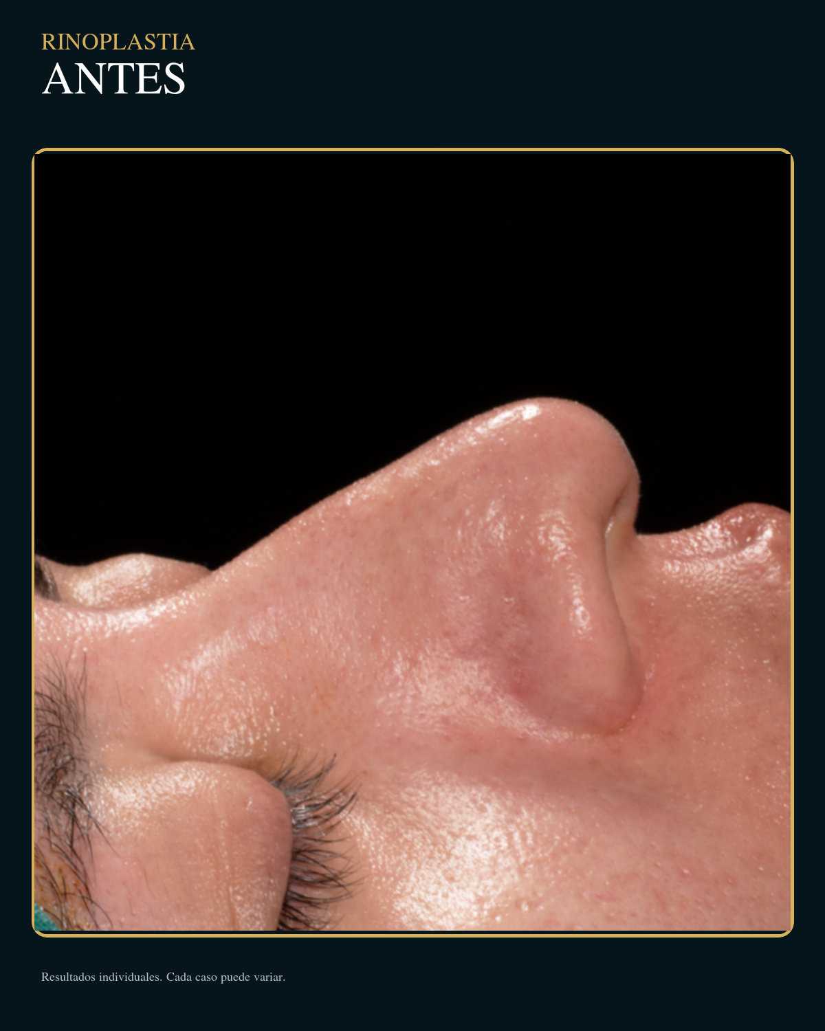 Antes de rinoplastia