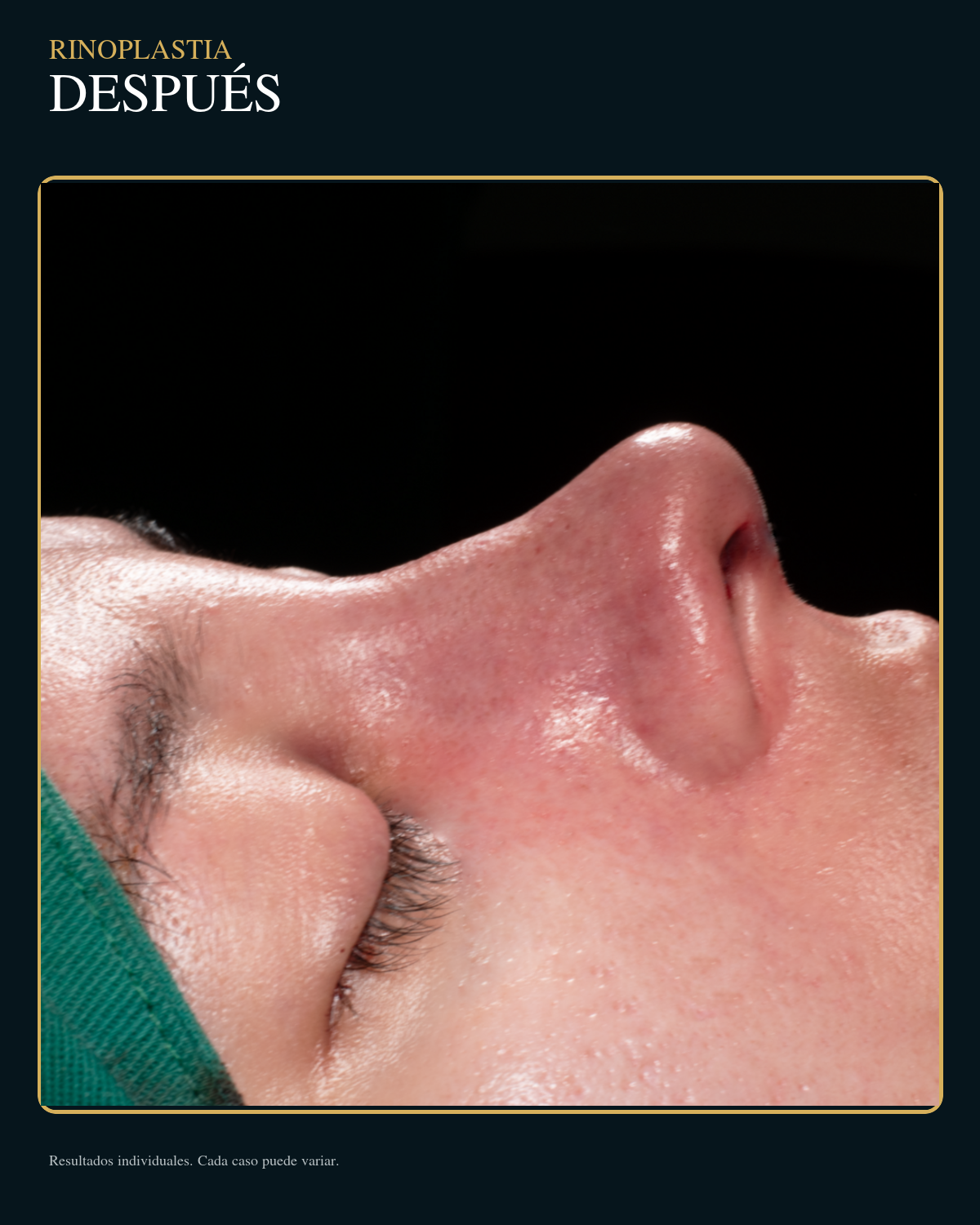 Después de rinoplastia