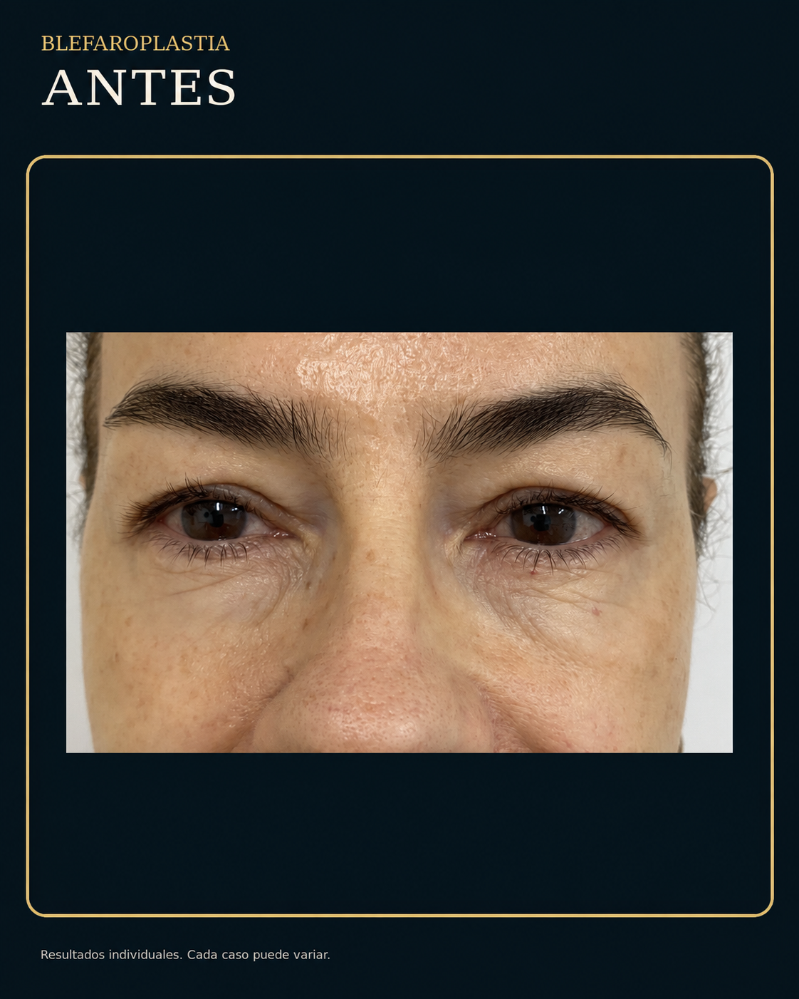 Antes de blefaroplastia