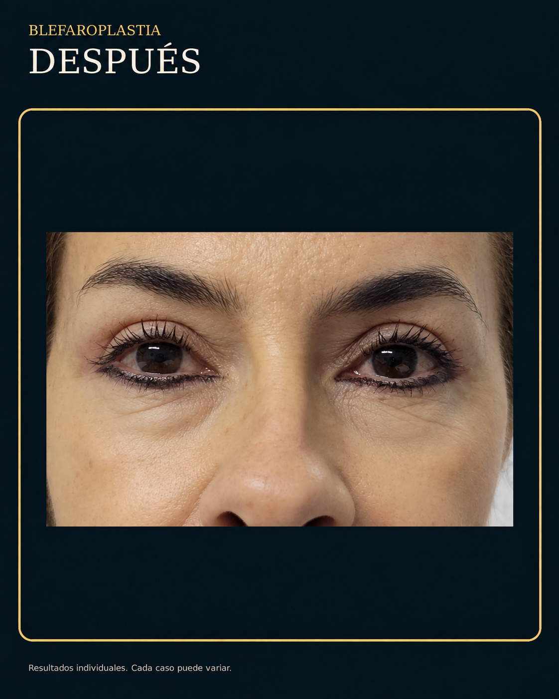 Después de blefaroplastia