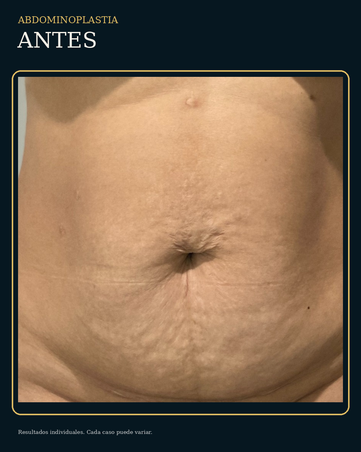 Antes de abdominoplastia