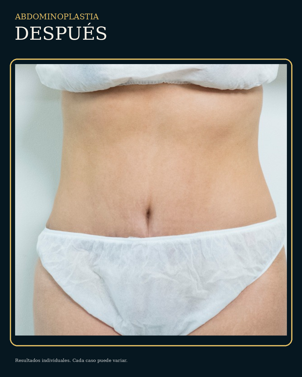 Después de abdominoplastia