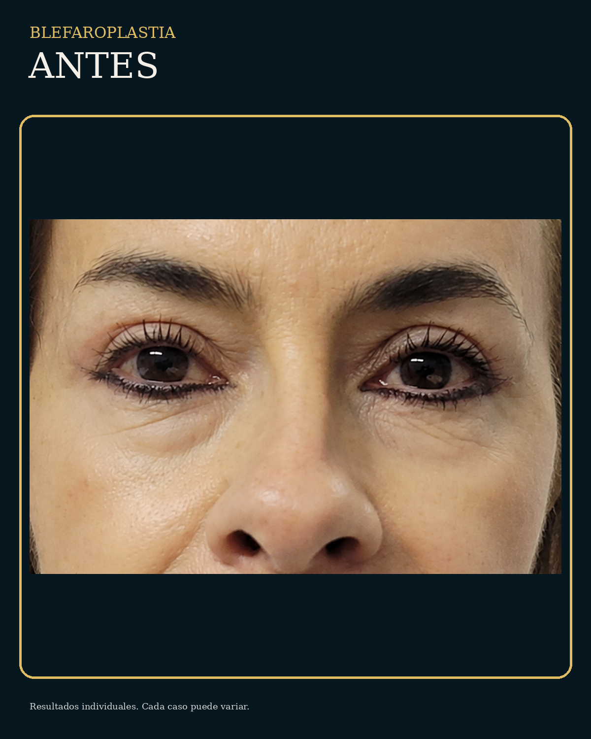 Antes de blefaroplastia