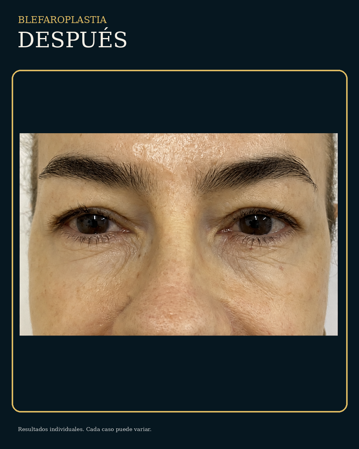 Después de blefaroplastia